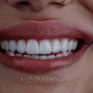 Lentes-de-Porcelana.png